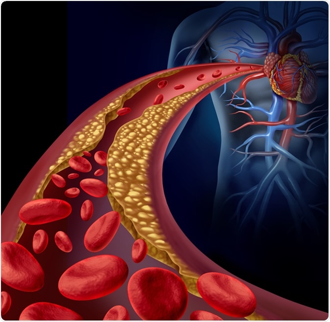 Clogged artery and atherosclerosis disease medical concept with a three dimensional human artery with blood cells that is blocked by plaque buildup of cholesterol as a symbol of vascular diseases. Image Credit: Lightspring / Shutterstock